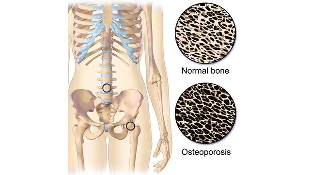 1149-osteoporosis-642x361-slide1