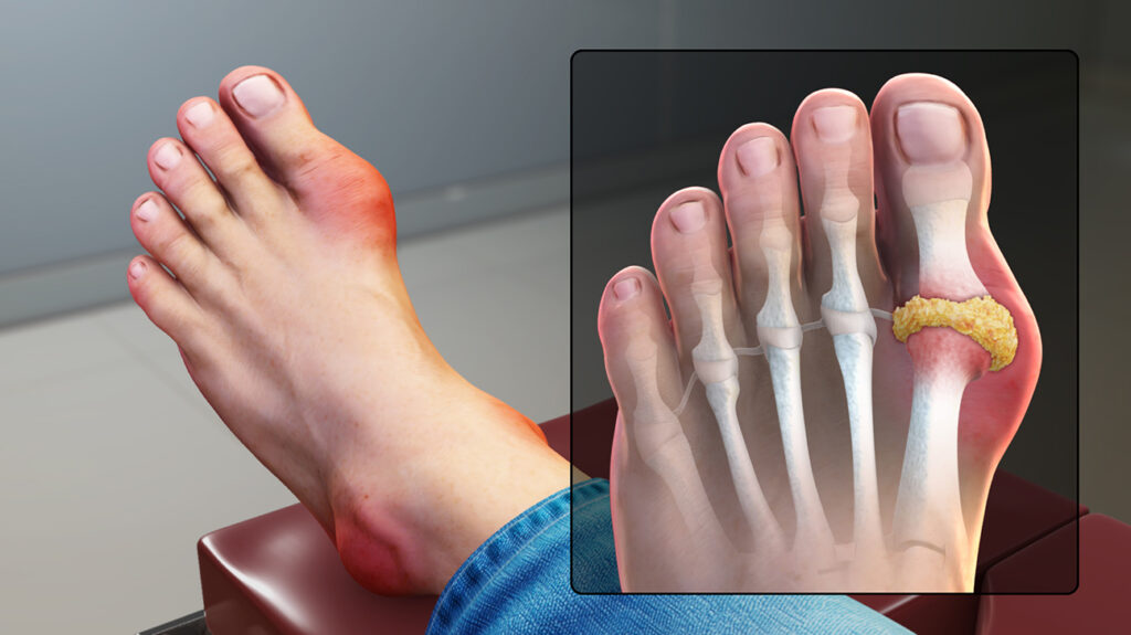 Gout_Signs_and_Symptoms_header-1024x575