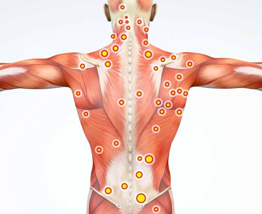 myofascial_pain_syndrome_trigger_points_99450800_ML_cropped